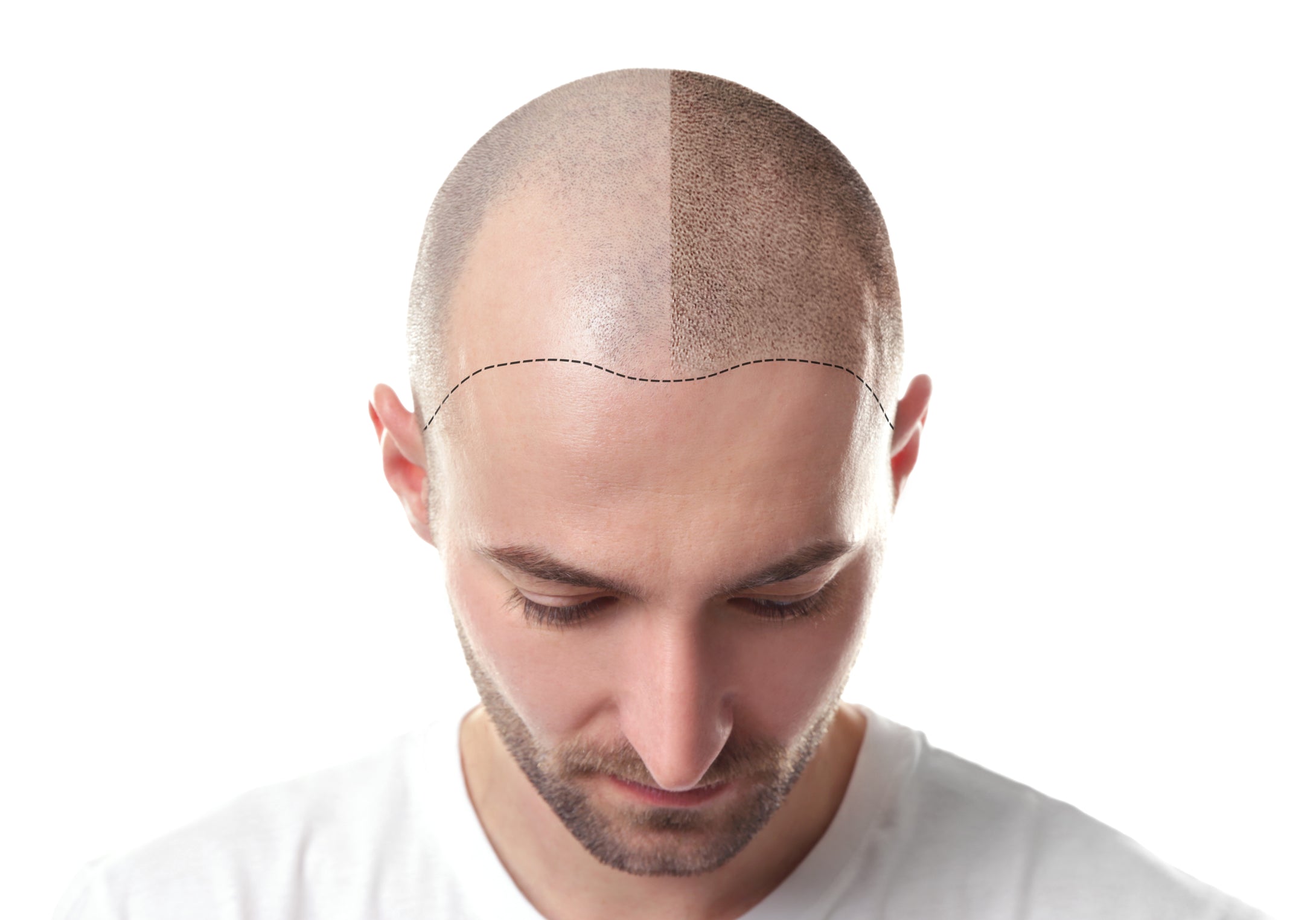 Hair loss and all the stages of the process